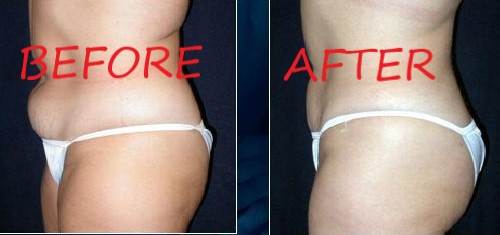 قبل و بعد شفط الدهون