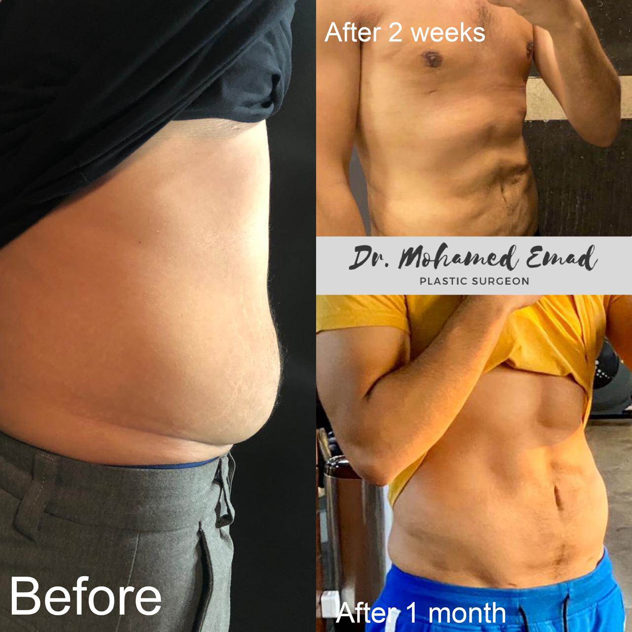 شفط الدهون قبل و بعد