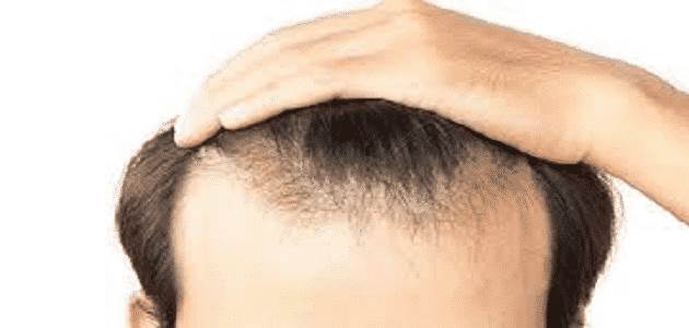 نصائح بعد عملية زراعة الشعر