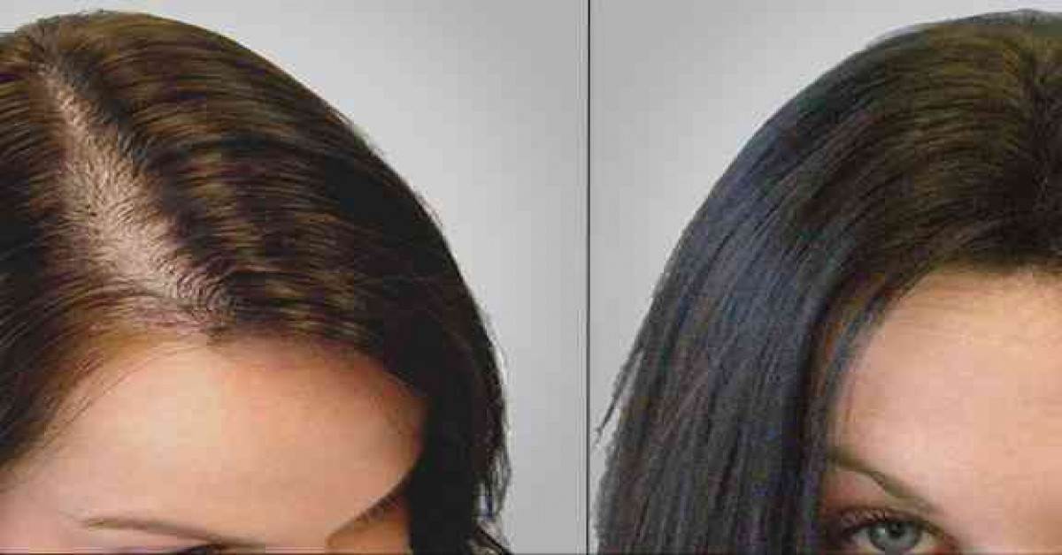 قبل و بعد زراعة الشعر