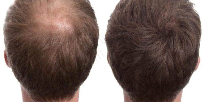 قبل و بعد زرعة الشعر