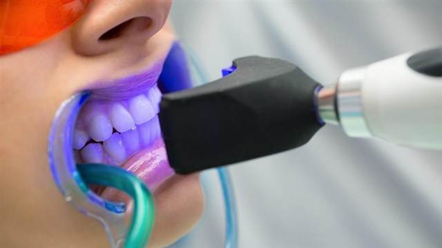 Doctor live | عملية تبييض الأسنان .. ما هي مميزاتها وسلبياتها؟