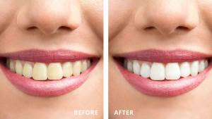 تلبيس الاسنان الاماميه بالصور قبل وبعد تجميل الاسنان في عيادة كوروش قشور للاسنان